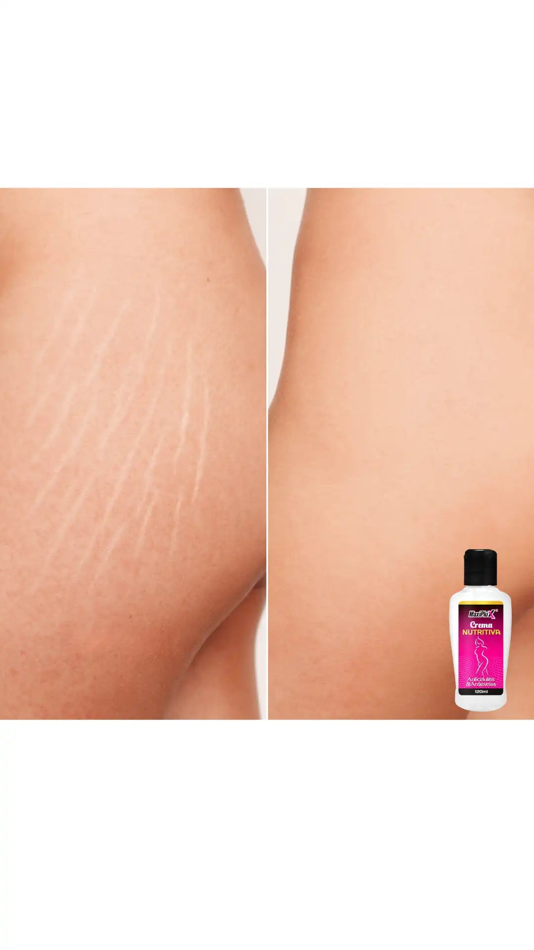 Crema eliminadora de estrías ➕ Envió gratis✨